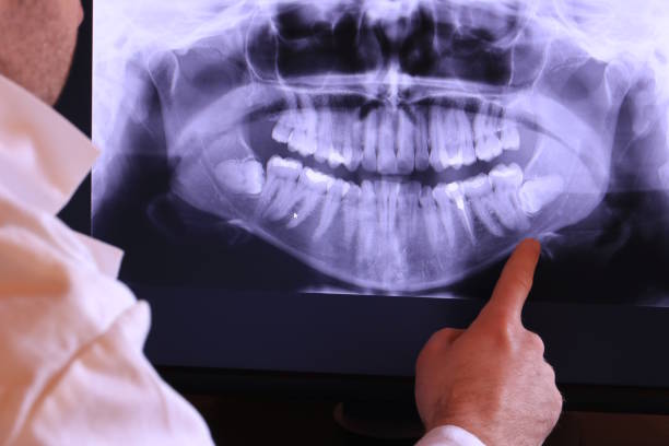 Best Emergency Wisdom Teeth Removal in Wise, VA